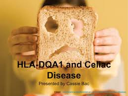 HLA-DQA1 Disease. 2022 Best HLA-DQA1 Disease.