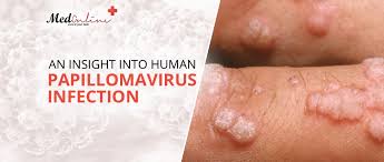 Human papillomavirus infection.