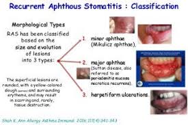 Recurrent Aphthous Stomatitis. 
