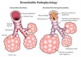 Treatment of bronchiolitis.