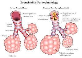 Treatment of bronchiolitis. 2022 Best Treatment of bronchiolitis.
