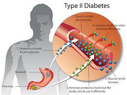 Type 2 diabetes. 2022 Best Type 2 diabetes.