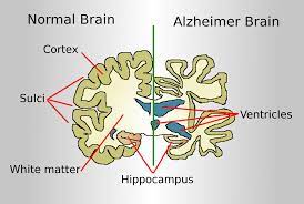 Alzheimer's Disease