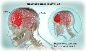 Traumatic brain injuries