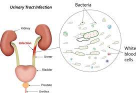 Urinary tract infections